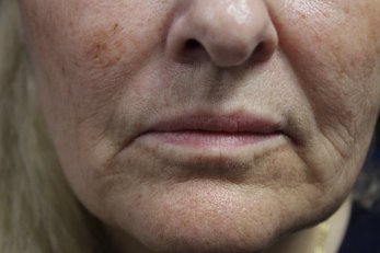 Vampire Facelift 2 - Before Treatment